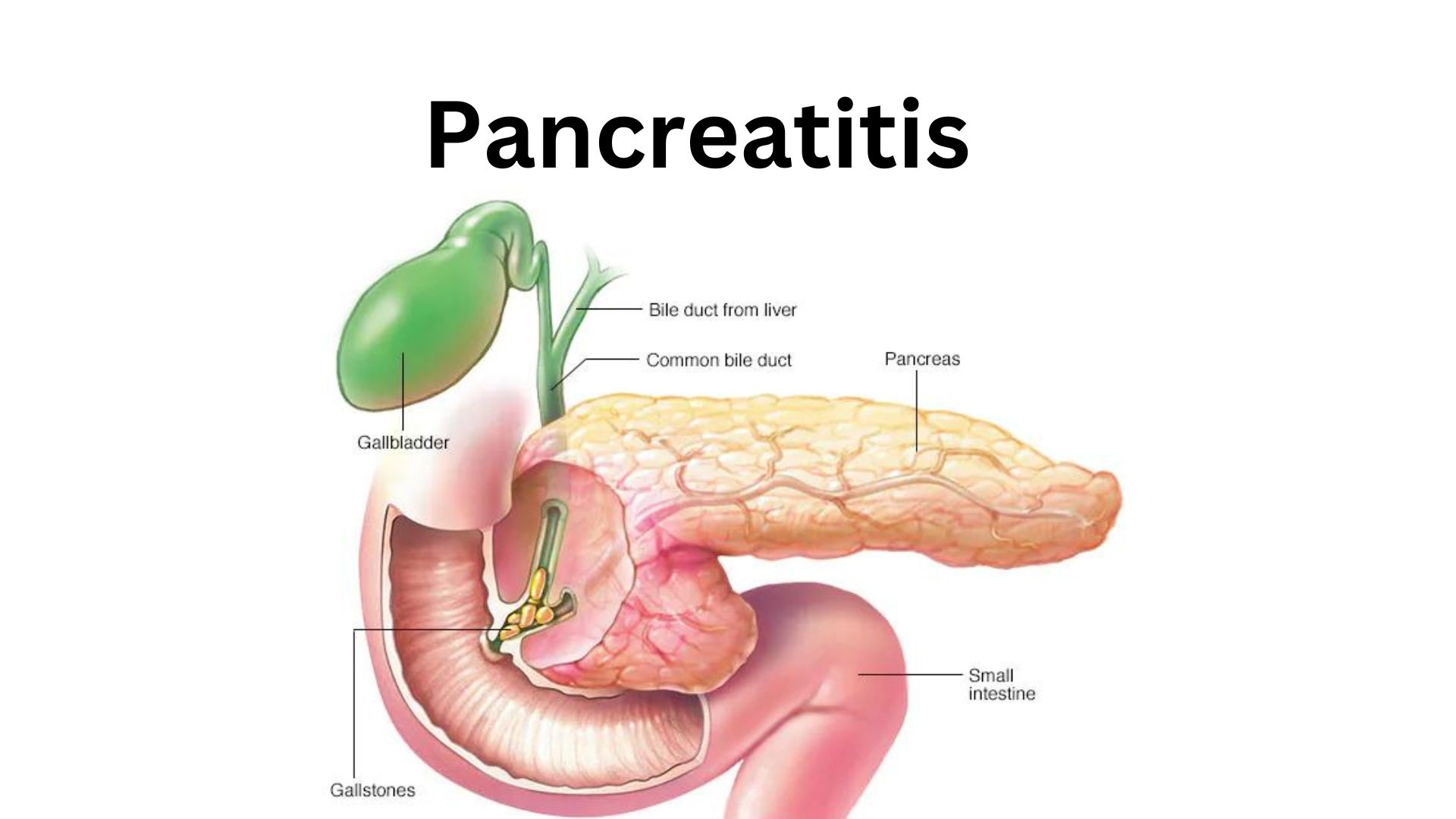 Trulicity Side Effects, Pancreatitis