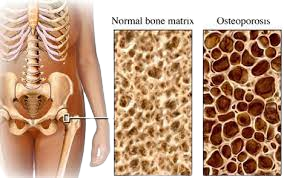 Bone Thinning, Side Effects of Kenalog Injection